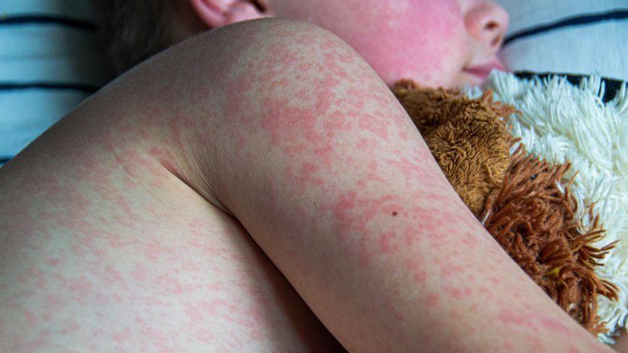 <who>Photo Credit: Northwestern Medicine</who>A child with measles.